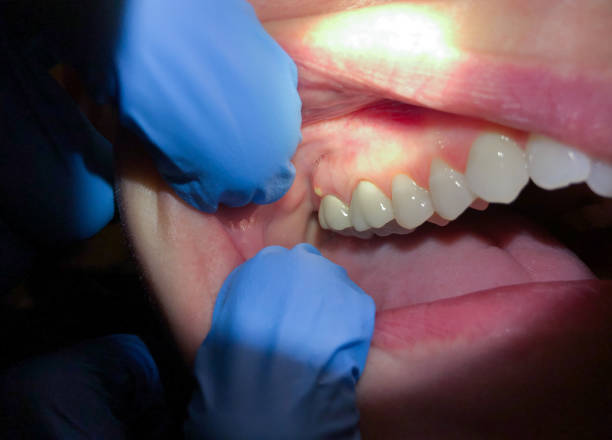 Best Broken or Chipped Tooth Repair in Boone, IA