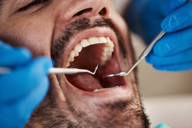 Best Knocked-Out Tooth (Avulsed Tooth) Treatment in Boone, IA