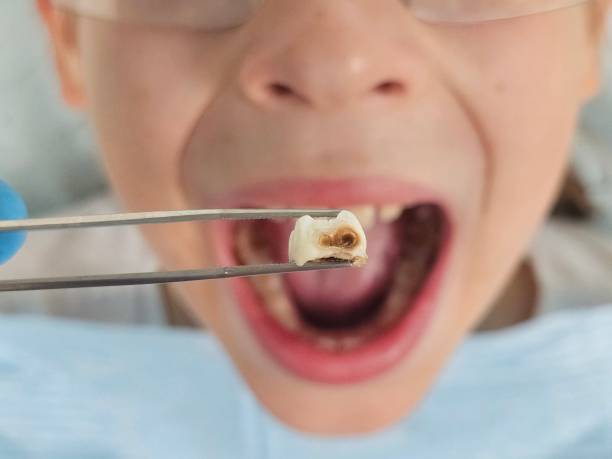Best Emergency Treatment for Oral Infections in Boone, IA